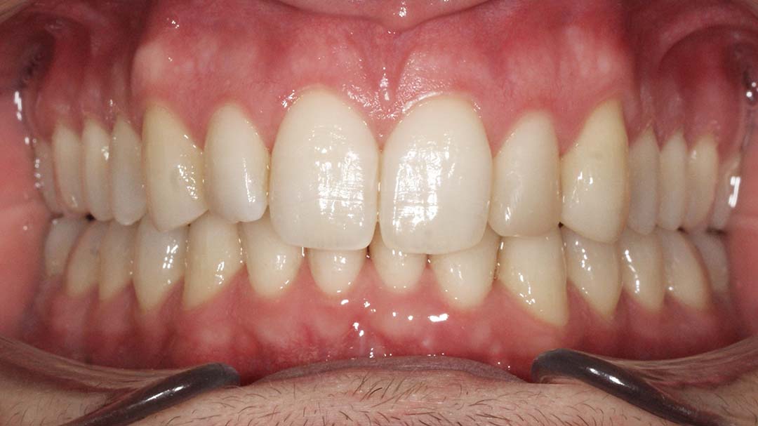 clinica olay dental pola de siero noreña asturias resultado pacientes