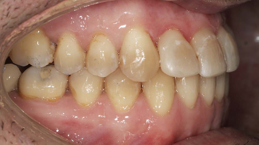 clinica olay dental pola de siero noreña asturias resultado pacientes