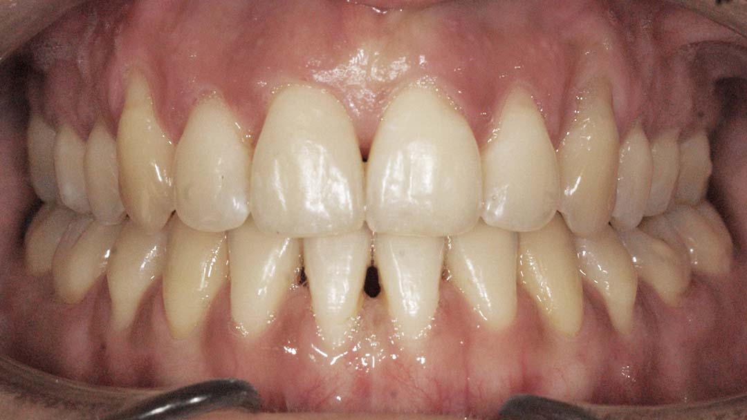 clinica olay dental pola de siero noreña asturias resultado pacientes