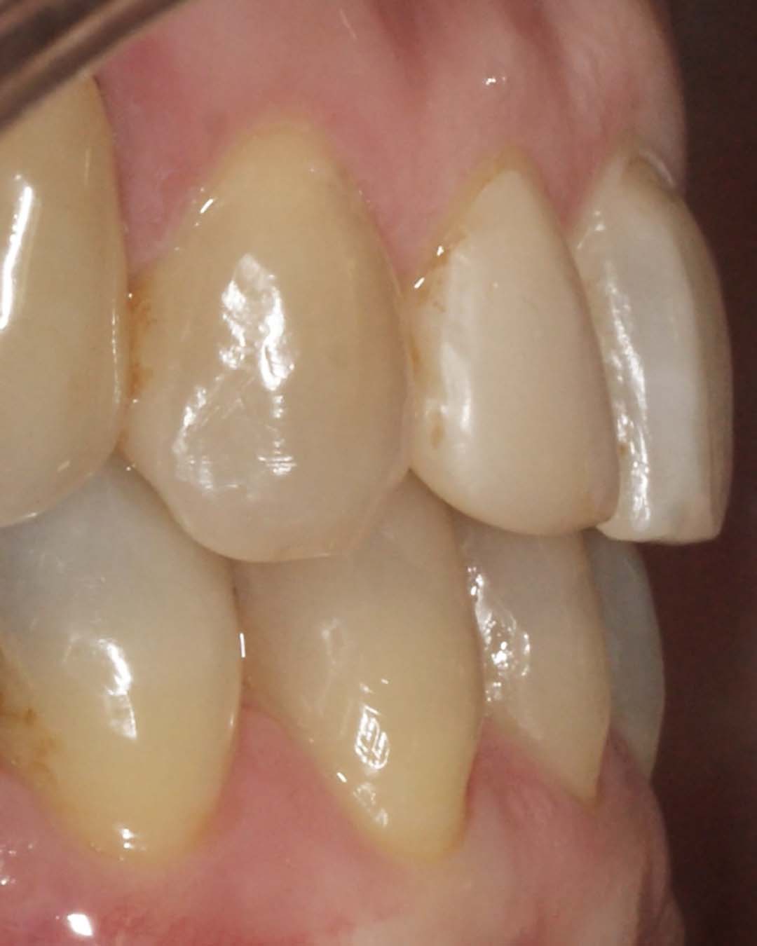 clinica olay dental pola de siero noreña asturias resultado pacientes