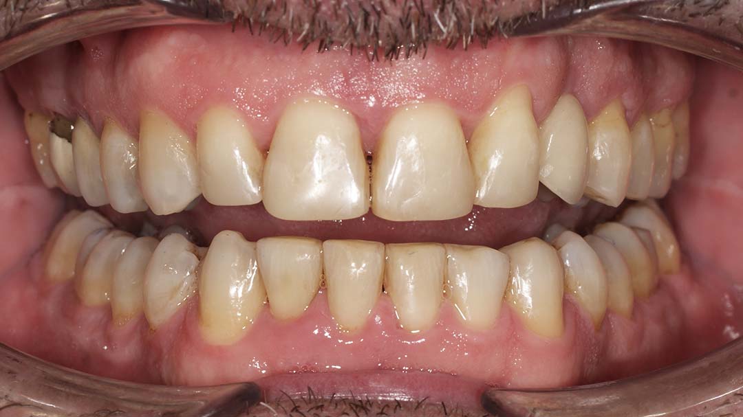 clinica olay dental pola de siero noreña asturias resultado pacientes