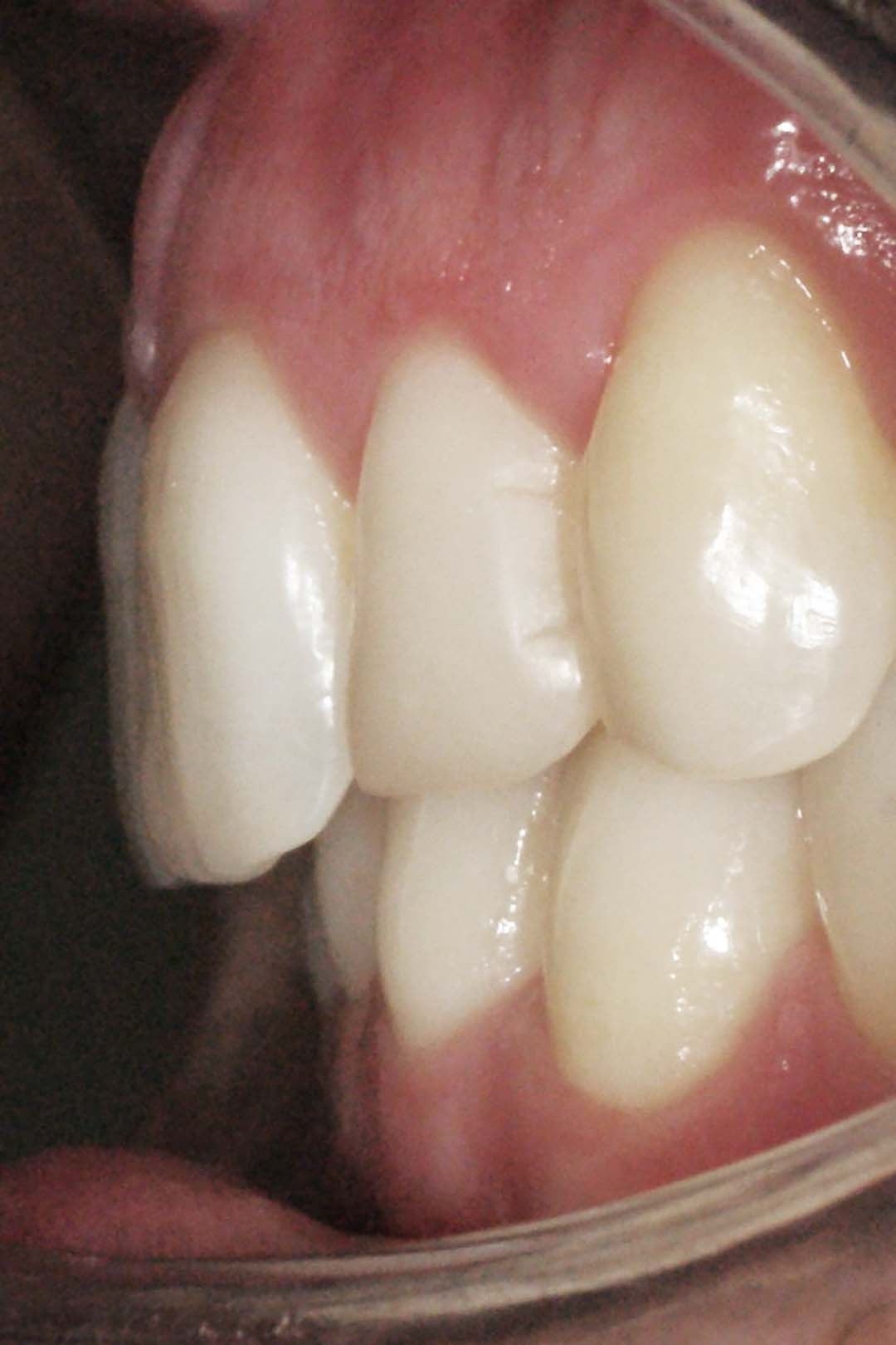 clinica olay dental pola de siero noreña asturias resultado pacientes