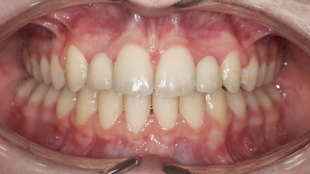 clinica olay dental pola de siero noreña asturias resultado pacientes