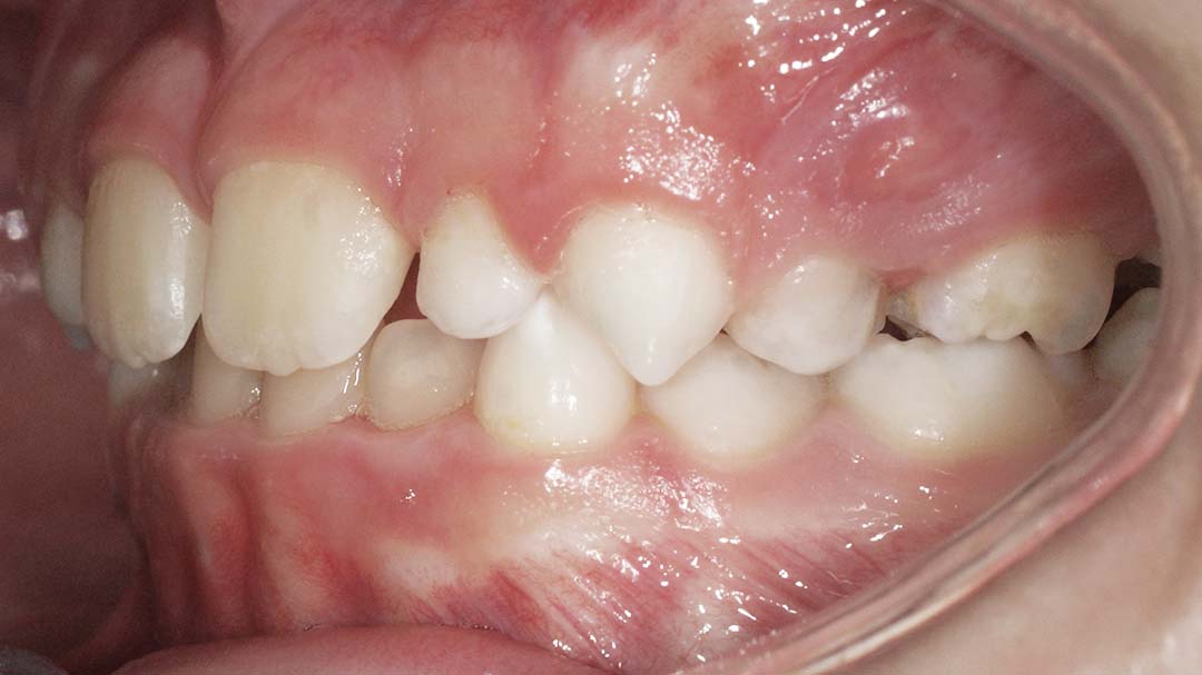 clinica olay dental pola de siero noreña asturias resultado pacientes