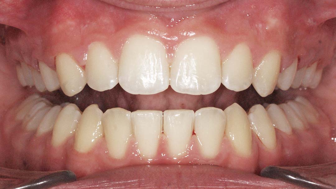 clinica olay dental pola de siero noreña asturias resultado pacientes